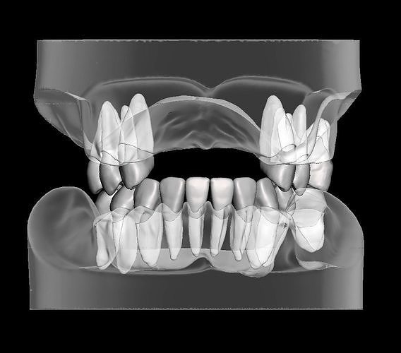 Partial edentulous model with individual teeth 3D print model