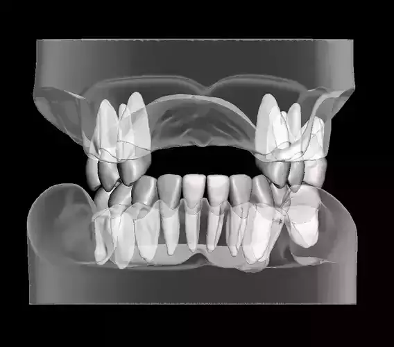 Partial edentulous model with individual teeth 3D print model