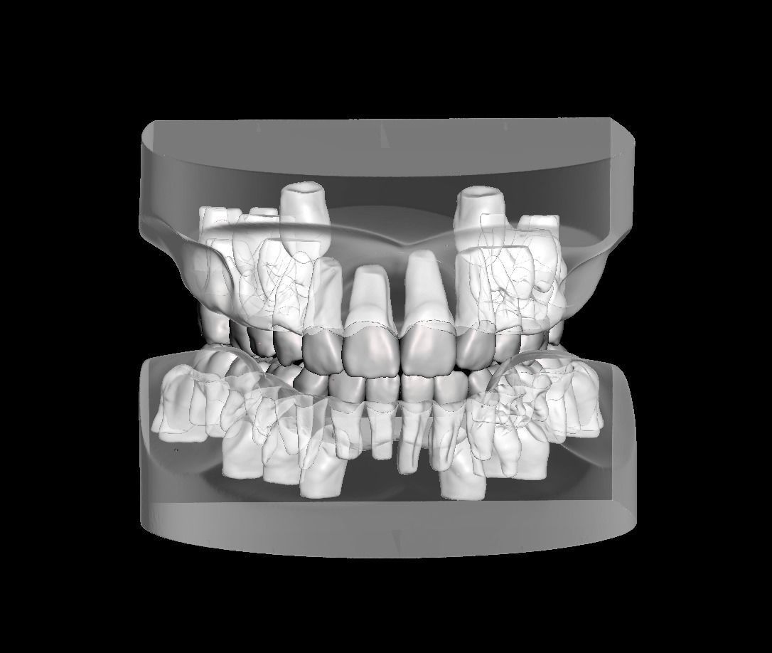 Mix dentition model with individual teeth 3D print model_2