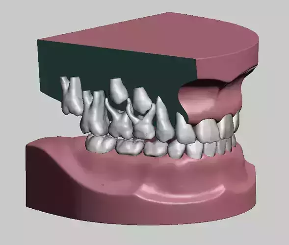 Mix dentition model with individual teeth 3D print model