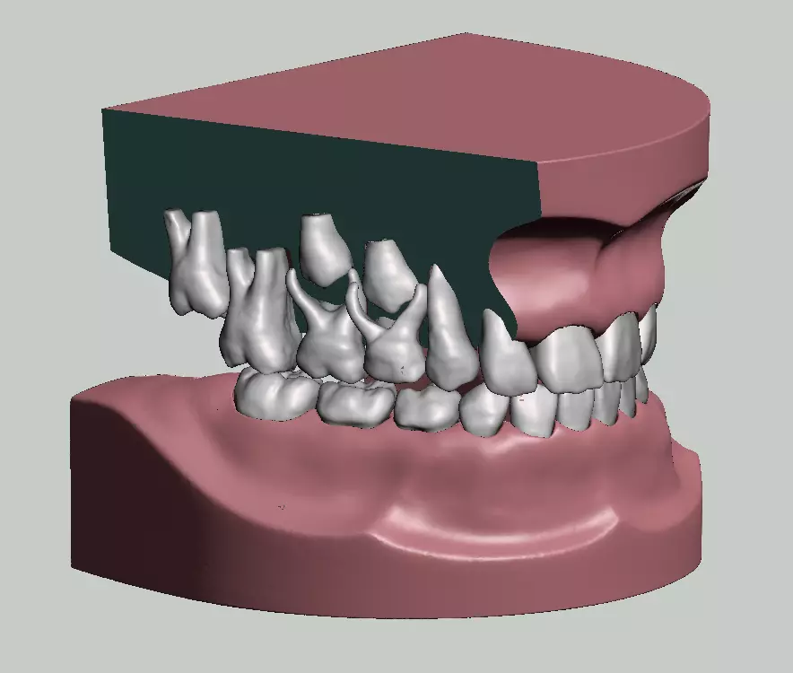 Mix dentition model with individual teeth 3D print model_0