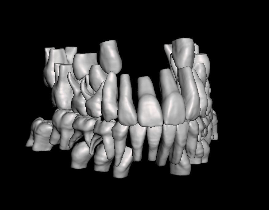 Mix dentition model with individual teeth 3D print model_1