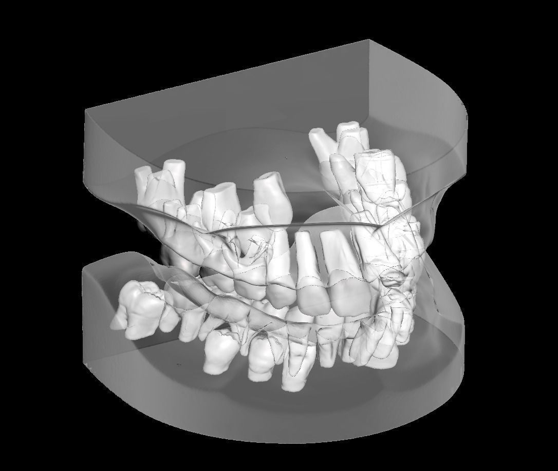 Mix dentition model with individual teeth 3D print model_3