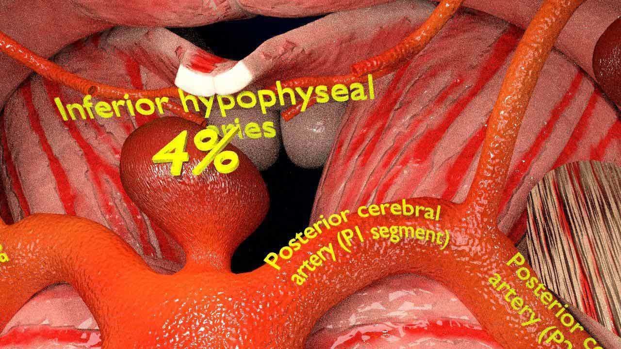Cerebral aneurysms berry circle of willis 3D model_7