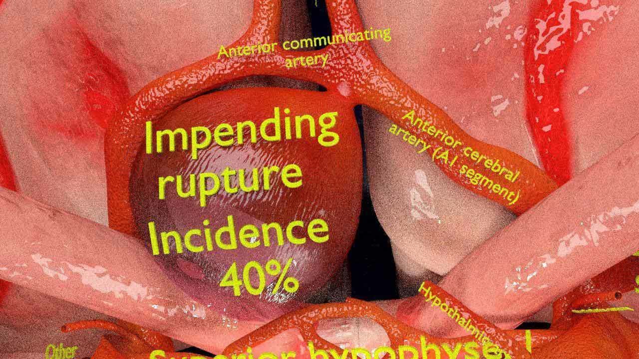 Cerebral aneurysms berry circle of willis 3D model_8