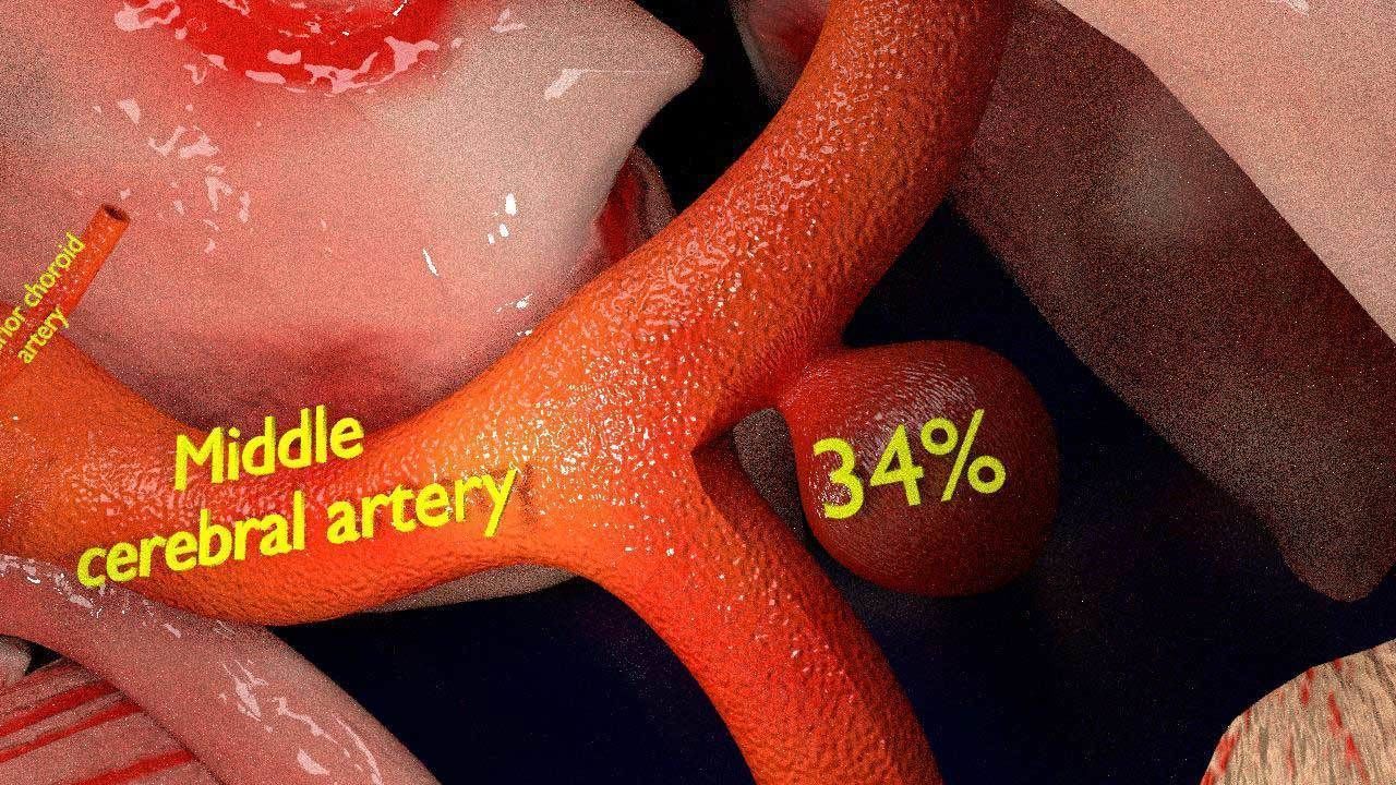 Cerebral aneurysms berry circle of willis 3D model_9