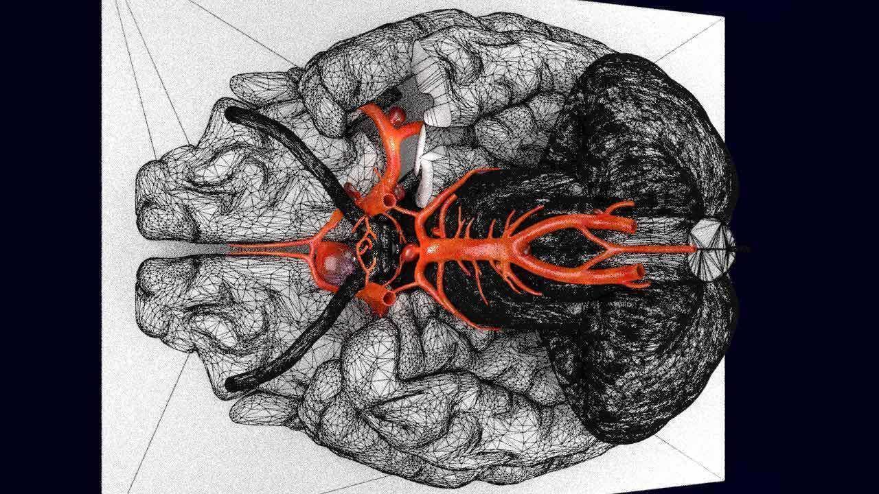 Cerebral aneurysms berry circle of willis 3D model_14