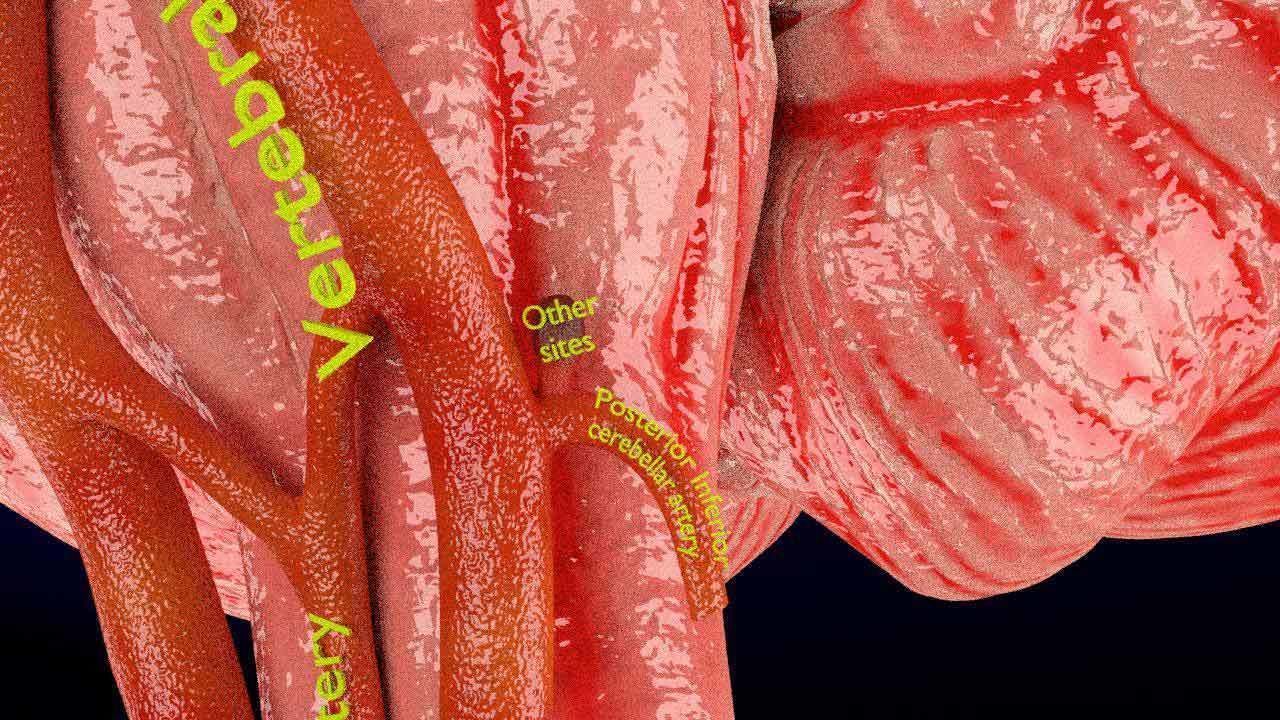 Cerebral aneurysms berry circle of willis 3D model_3