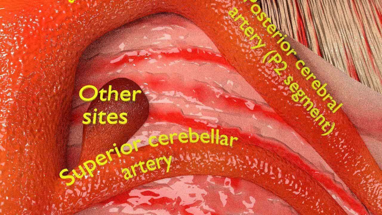 Cerebral aneurysms berry circle of willis 3D model_6