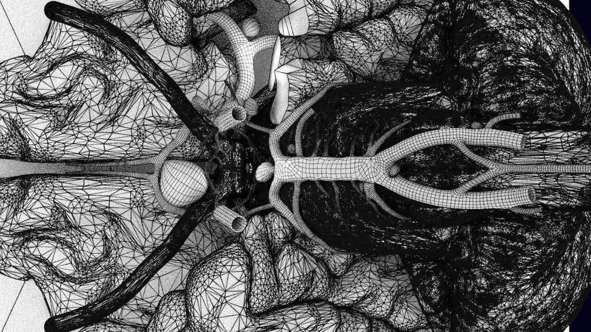 Cerebral aneurysms berry circle of willis 3D model_18