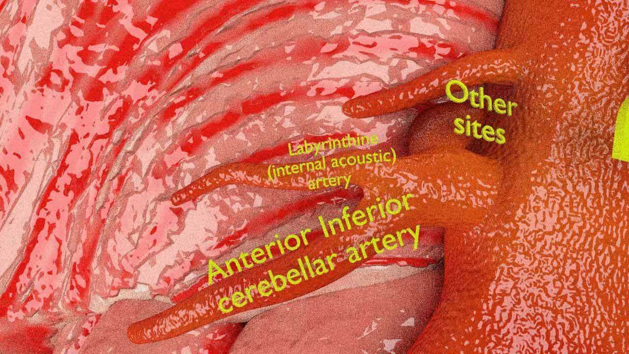 Cerebral aneurysms berry circle of willis 3D model_5