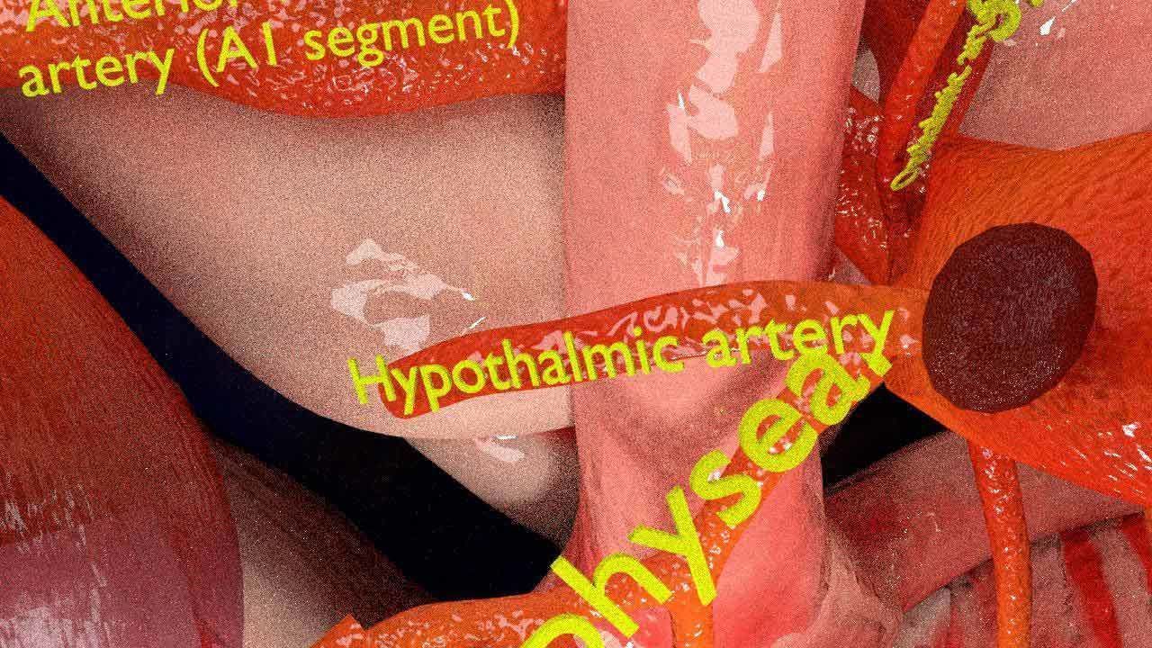 Cerebral aneurysms berry circle of willis 3D model_11