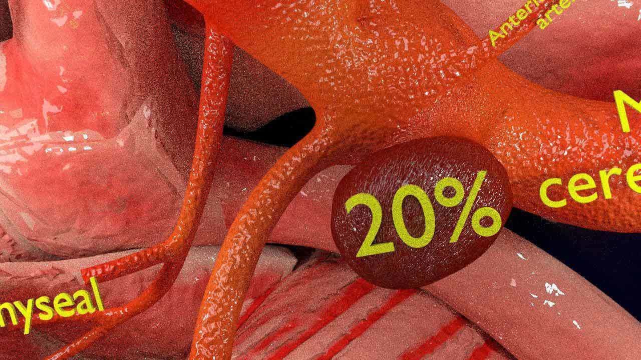 Cerebral aneurysms berry circle of willis 3D model_10