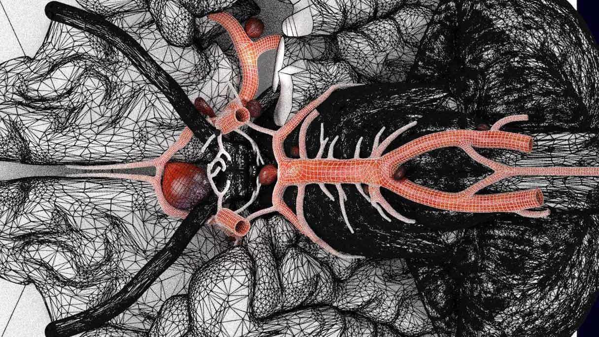 Cerebral aneurysms berry circle of willis 3D model_15