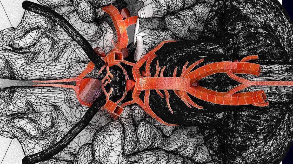 Cerebral aneurysms berry circle of willis 3D model_16