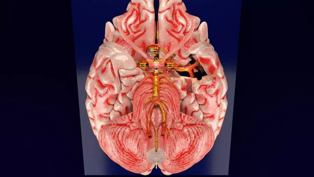 Cerebral aneurysms berry circle of willis 3D model_0