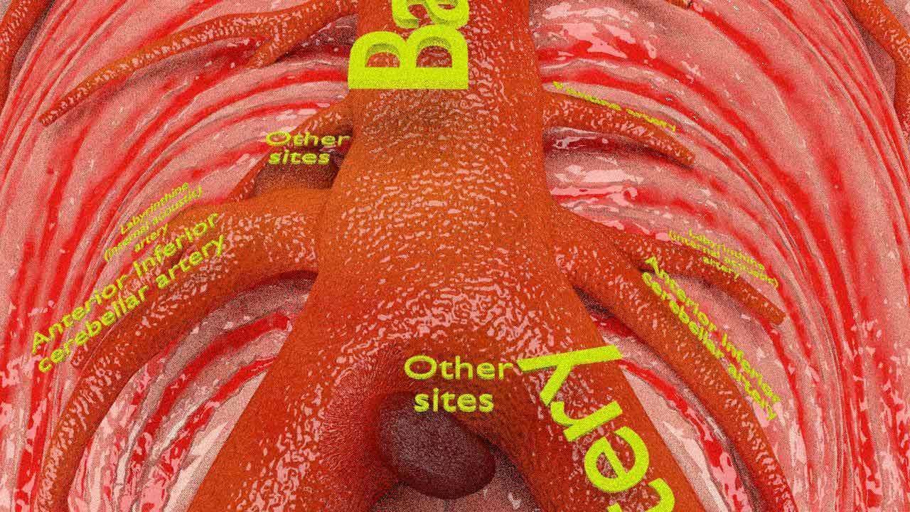 Cerebral aneurysms berry circle of willis 3D model_4