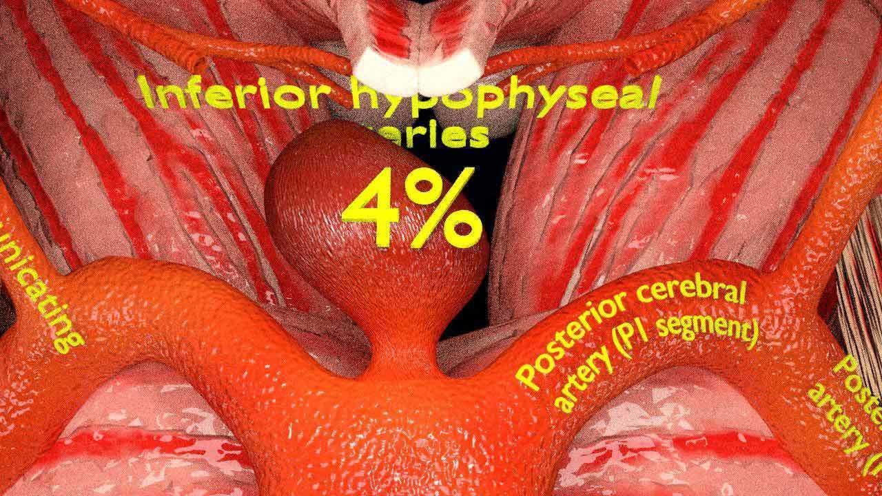Cerebral aneurysms berry circle of willis 3D model_12