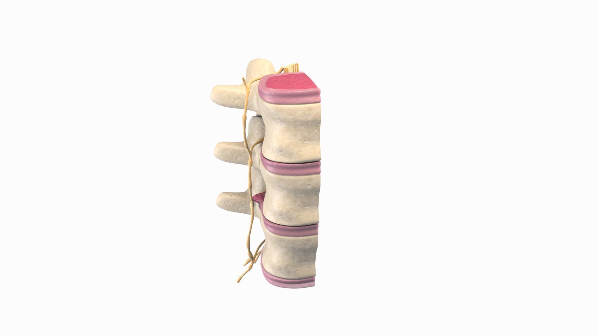 Slipped Bulging Herniated Herniation Disc Spine 3D model_2