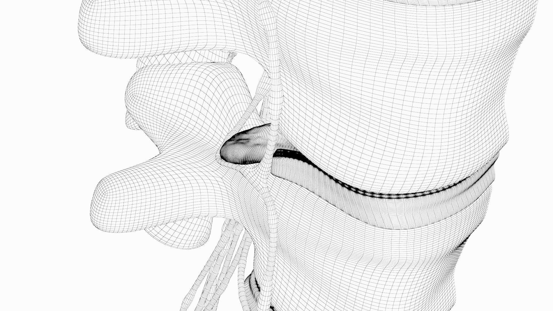 Slipped Bulging Herniated Herniation Disc Spine 3D model_35