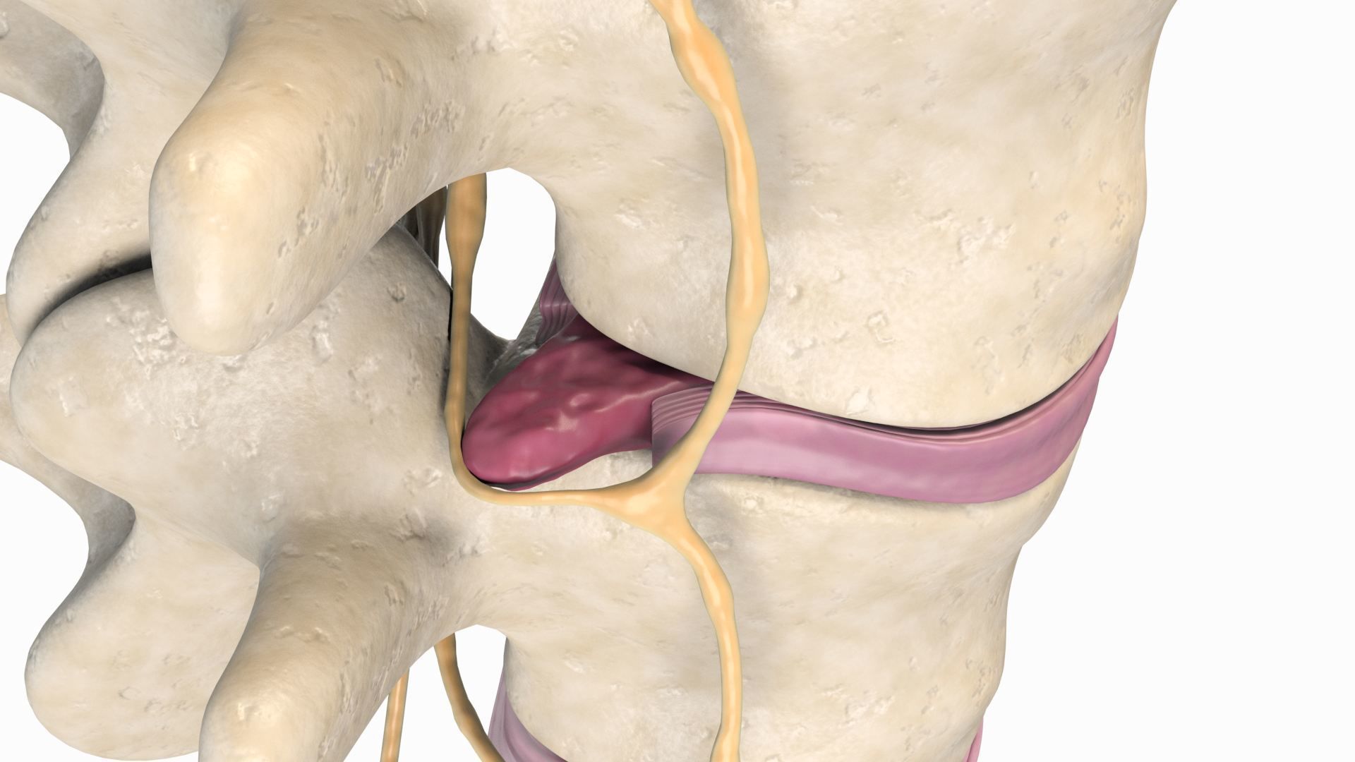 Slipped Bulging Herniated Herniation Disc Spine 3D model_10