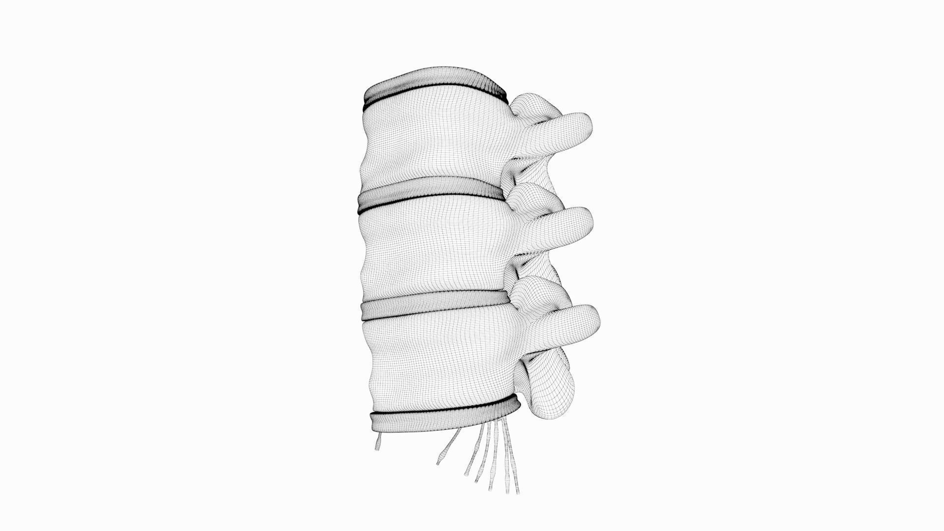 Slipped Bulging Herniated Herniation Disc Spine 3D model_48