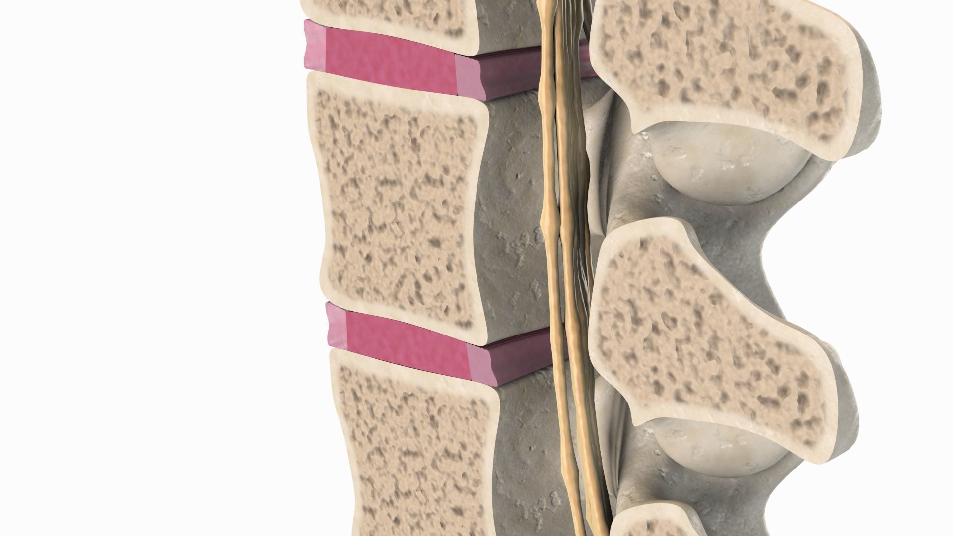 Slipped Bulging Herniated Herniation Disc Spine 3D model_11