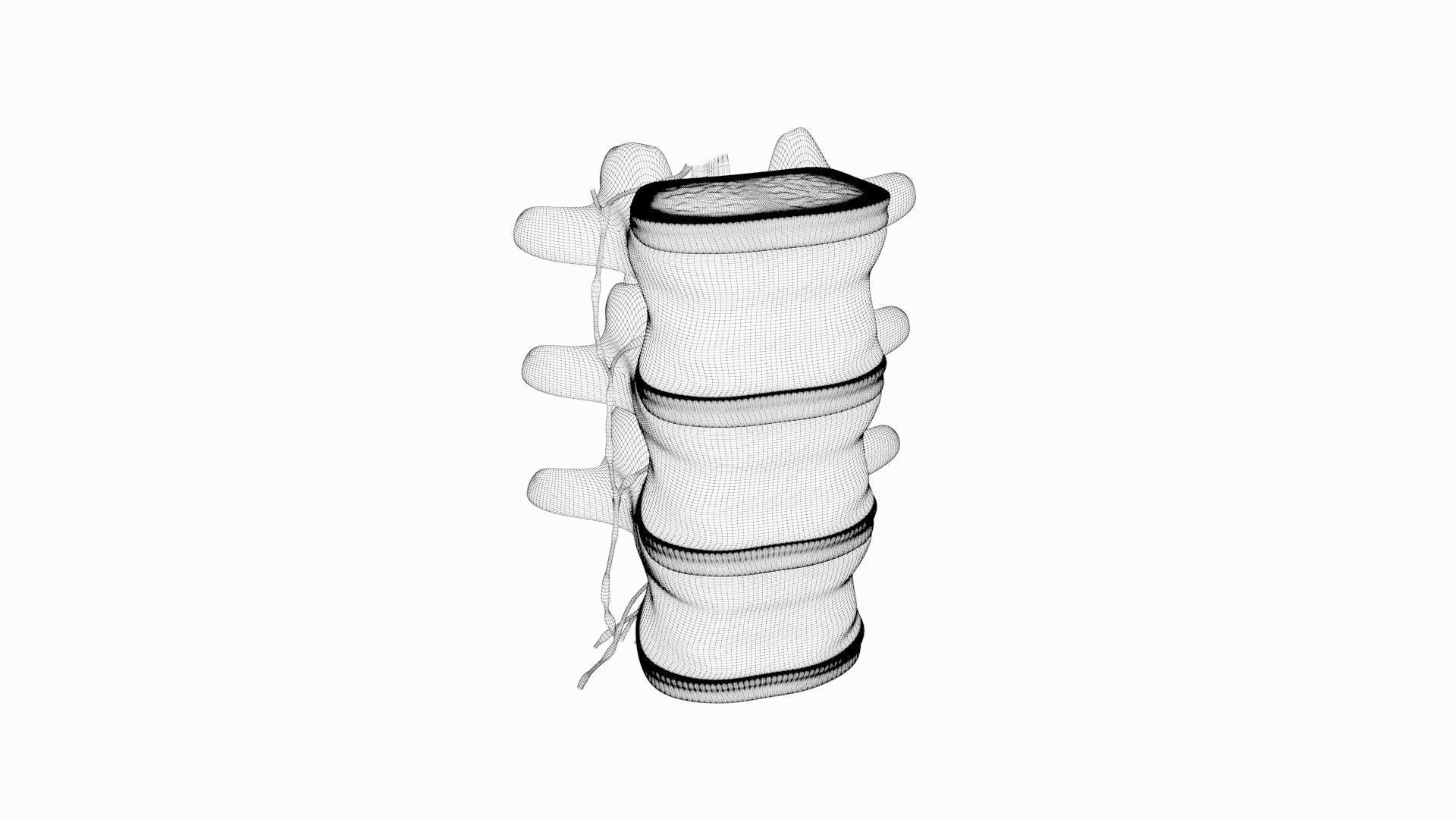 Slipped Bulging Herniated Herniation Disc Spine 3D model_43