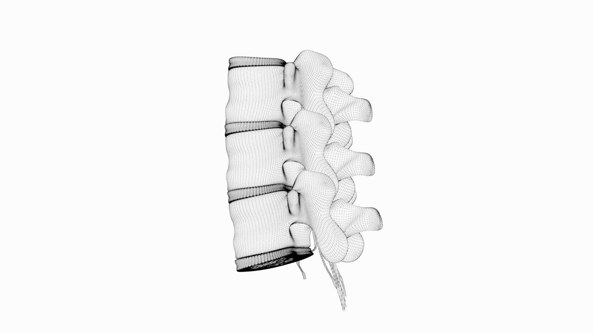 Slipped Bulging Herniated Herniation Disc Spine 3D model_47