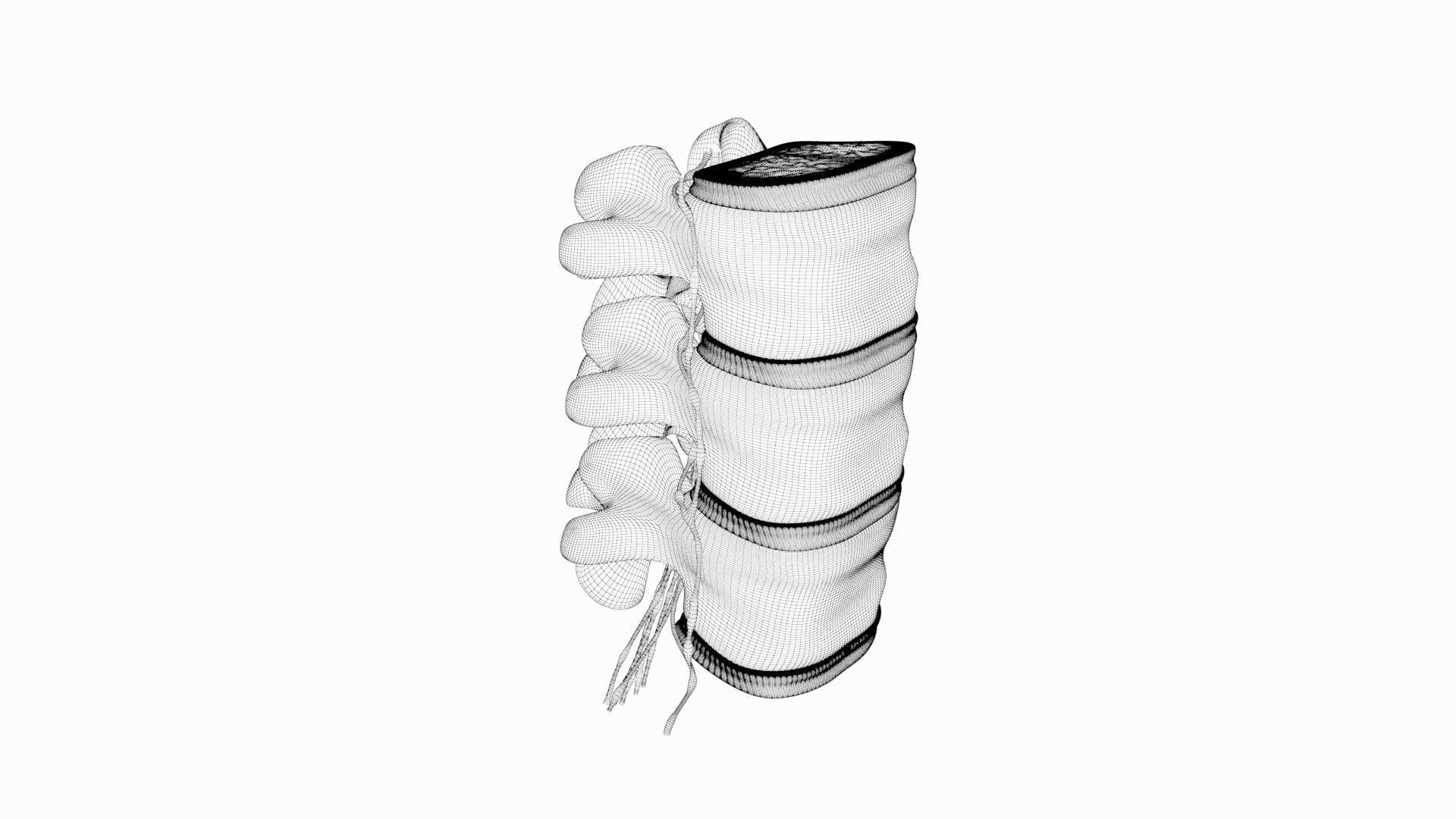 Slipped Bulging Herniated Herniation Disc Spine 3D model_44