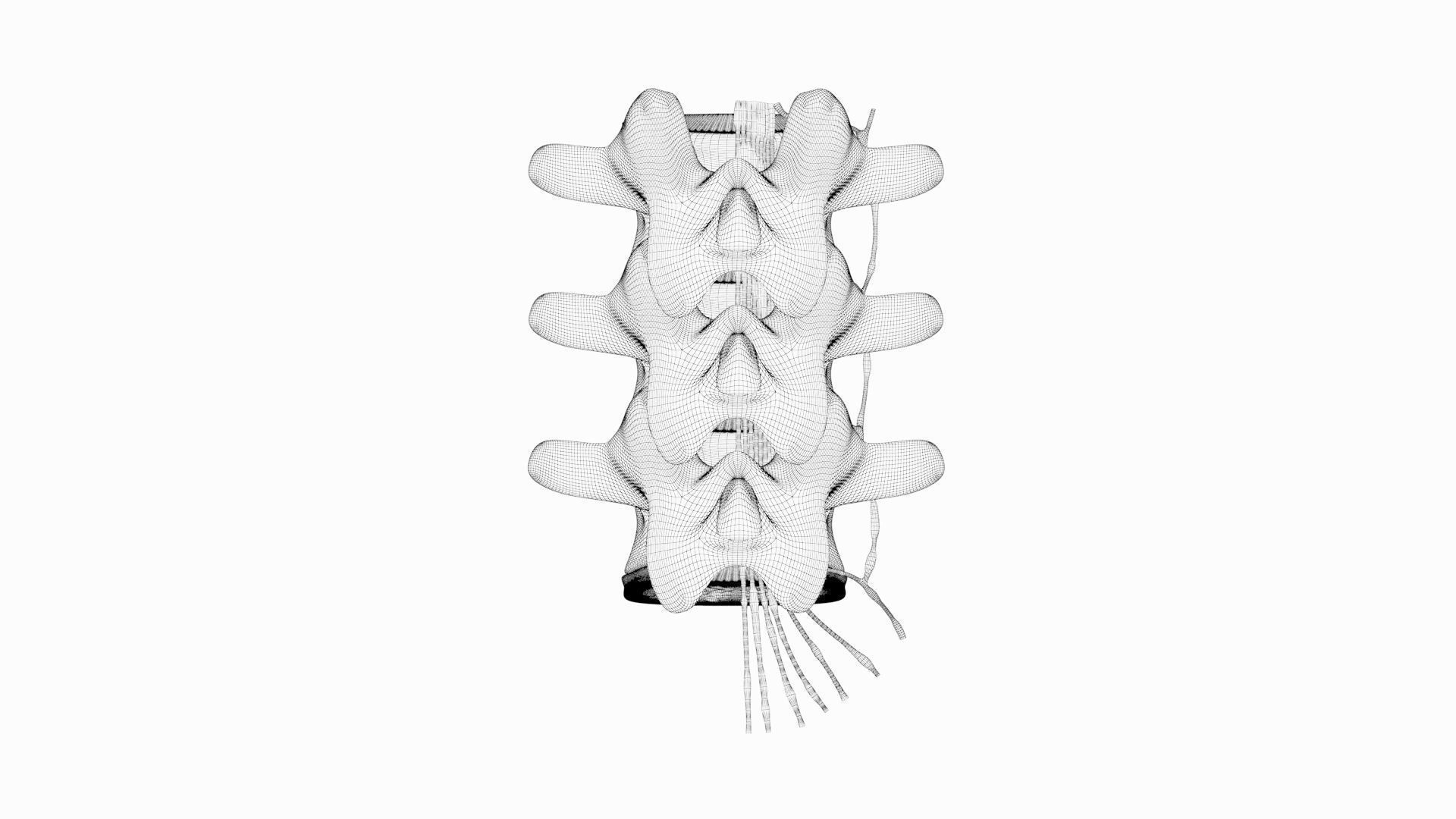 Slipped Bulging Herniated Herniation Disc Spine 3D model_46