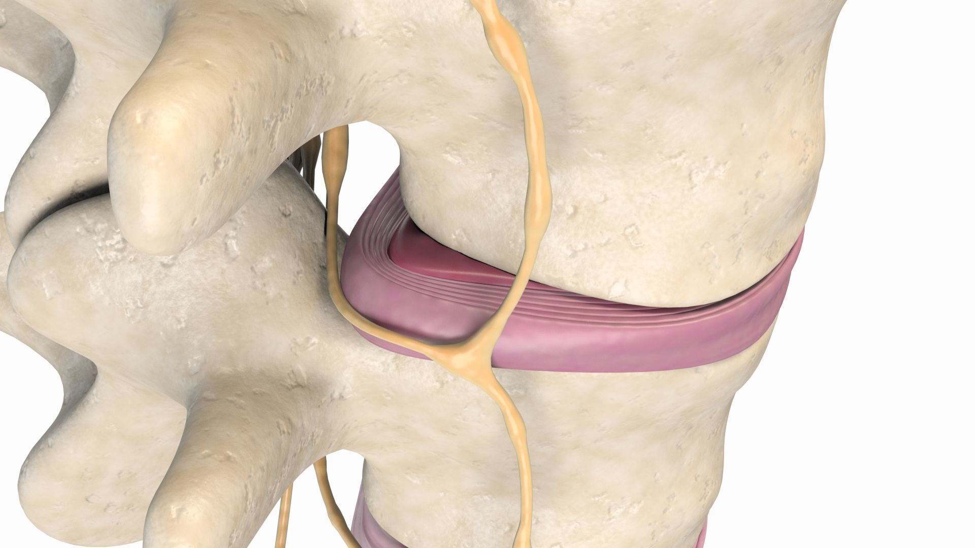 Slipped Bulging Herniated Herniation Disc Spine 3D model_24