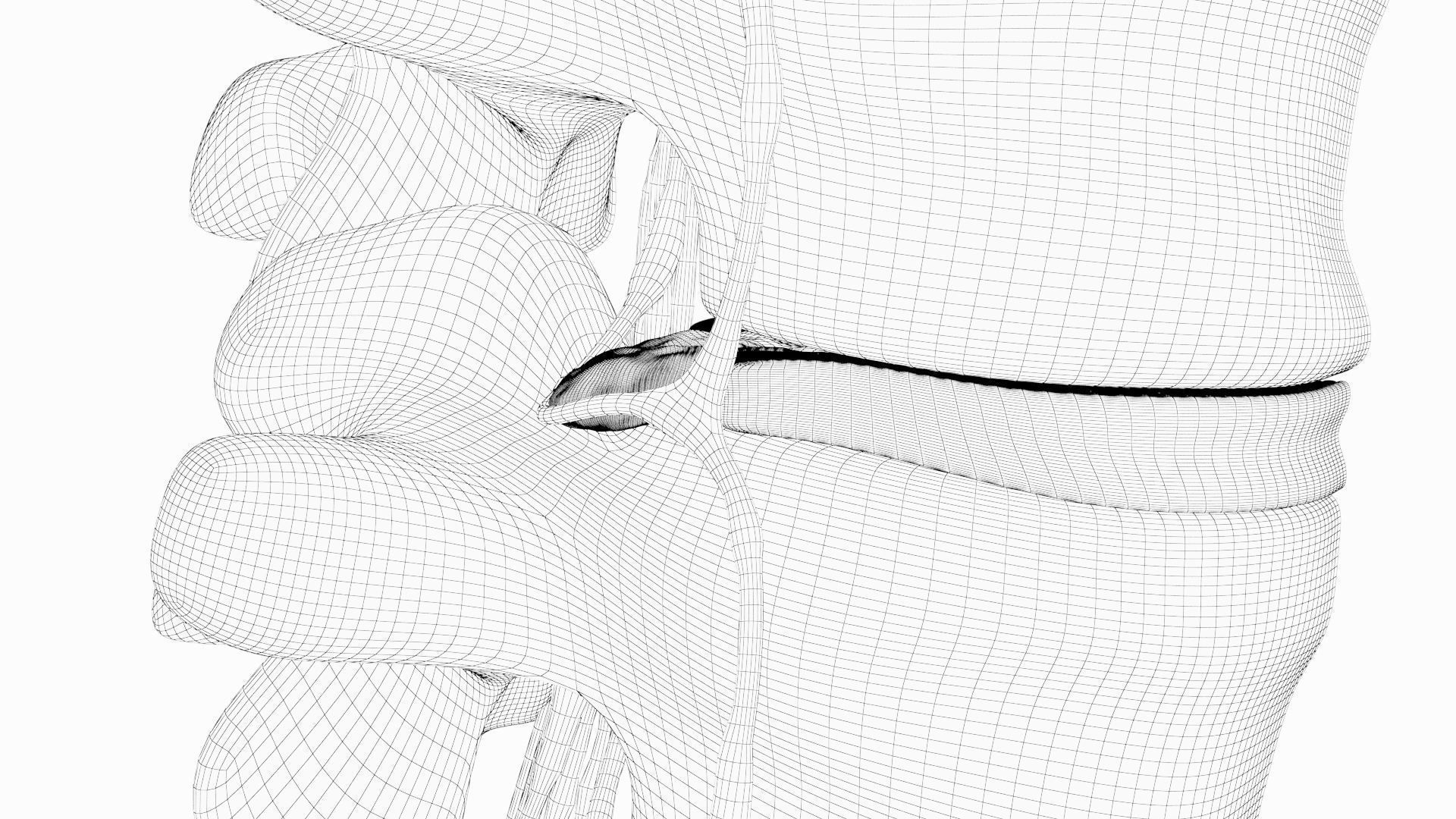 Slipped Bulging Herniated Herniation Disc Spine 3D model_36