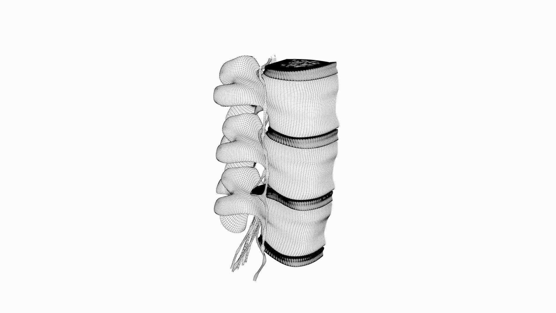 Slipped Bulging Herniated Herniation Disc Spine 3D model_30