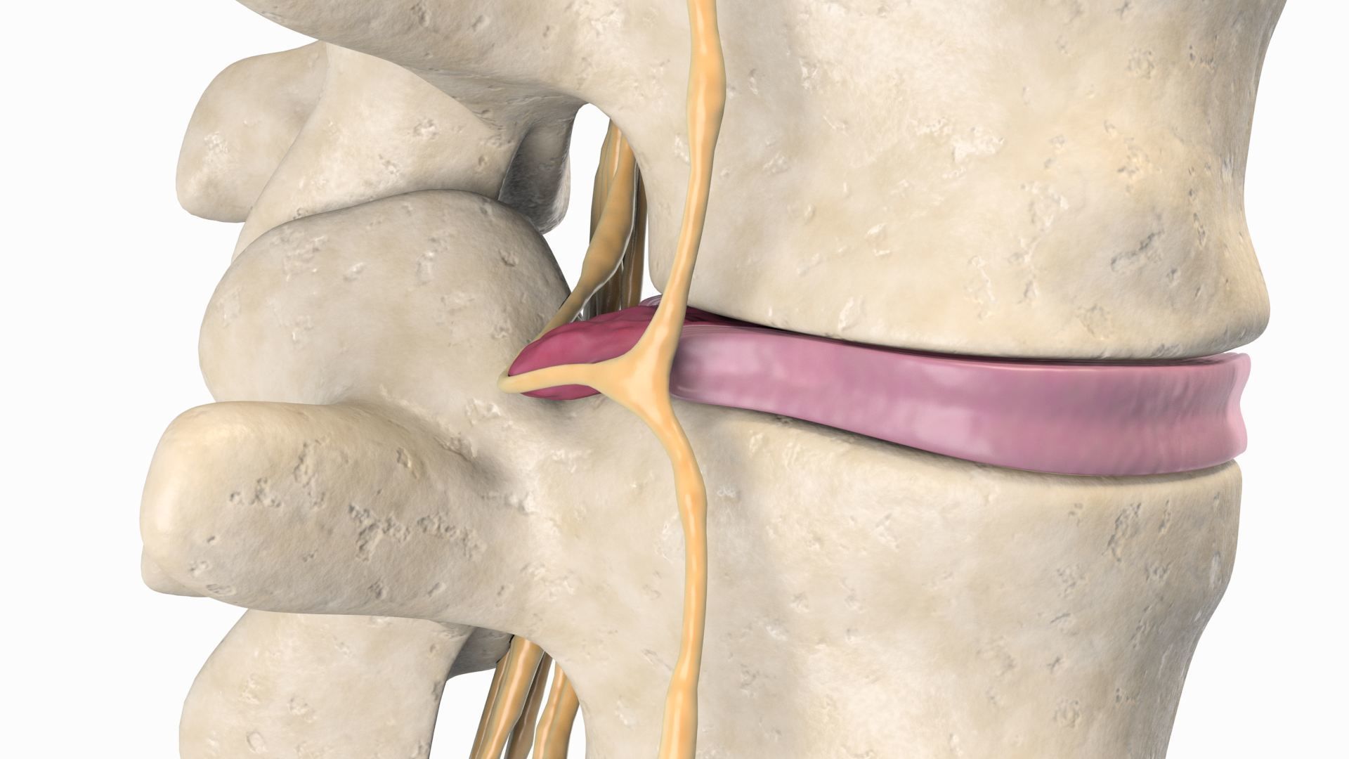 Slipped Bulging Herniated Herniation Disc Spine 3D model_9