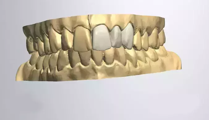 Dental model bridge 3D model
