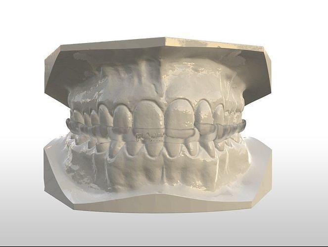 Full Coverage Occlusal Splint with Canine Guidance 3D print model