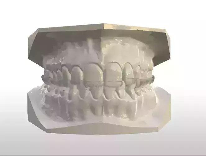 Full Coverage Occlusal Splint with Canine Guidance 3D print model