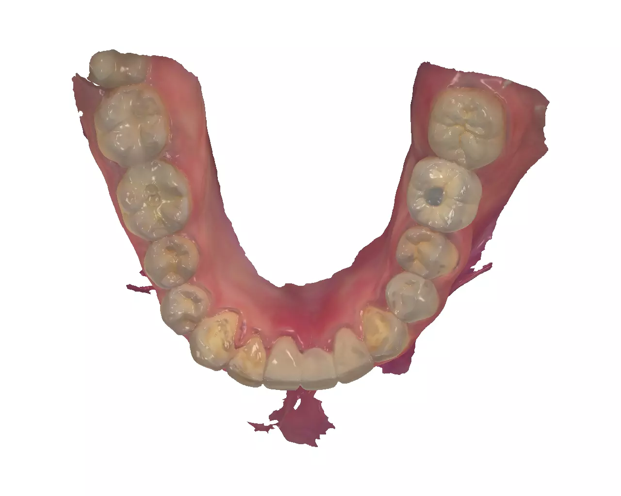 dental inlay model 3D print model