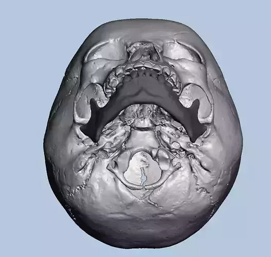 3D skull model converted from DICOM data 3D print model
