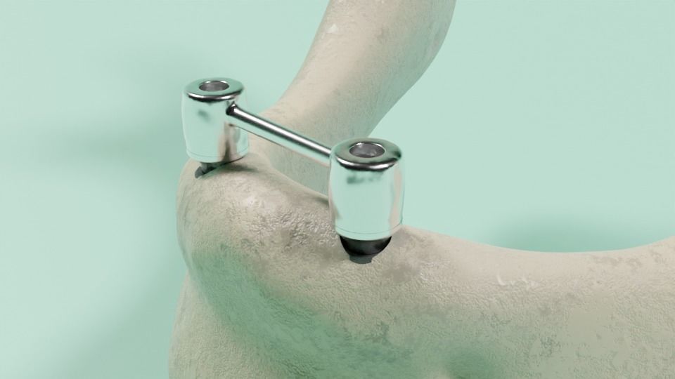 Overdenture - Bar-clip lower denture retained by implants 3D model_2