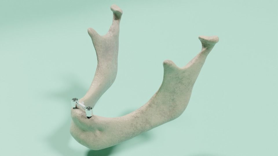 Overdenture - Bar-clip lower denture retained by implants 3D model_4