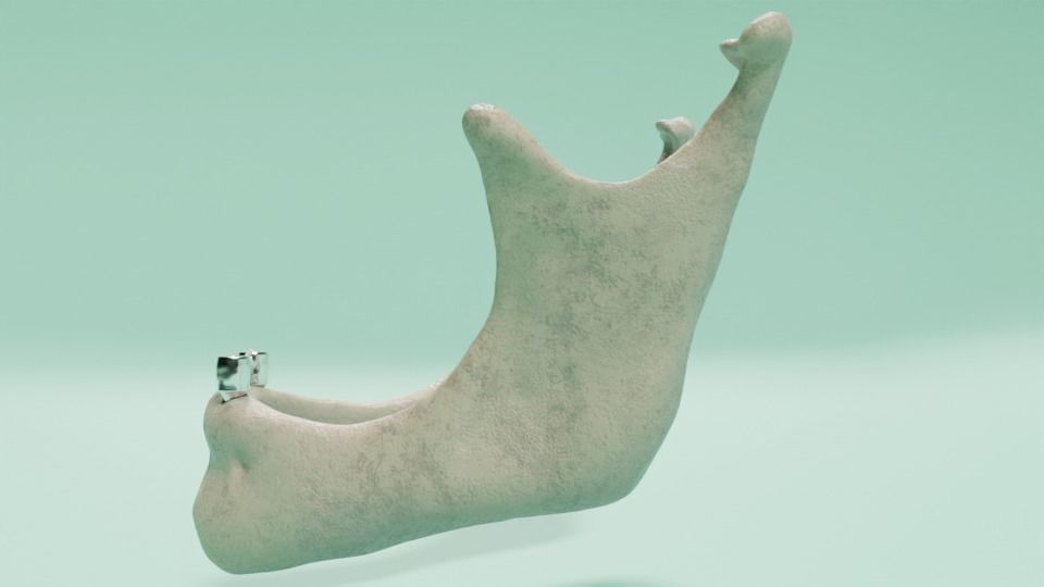 Overdenture - Bar-clip lower denture retained by implants 3D model_5