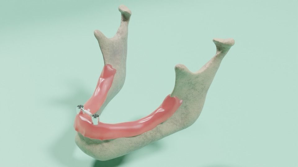 Overdenture - Bar-clip lower denture retained by implants 3D model_1