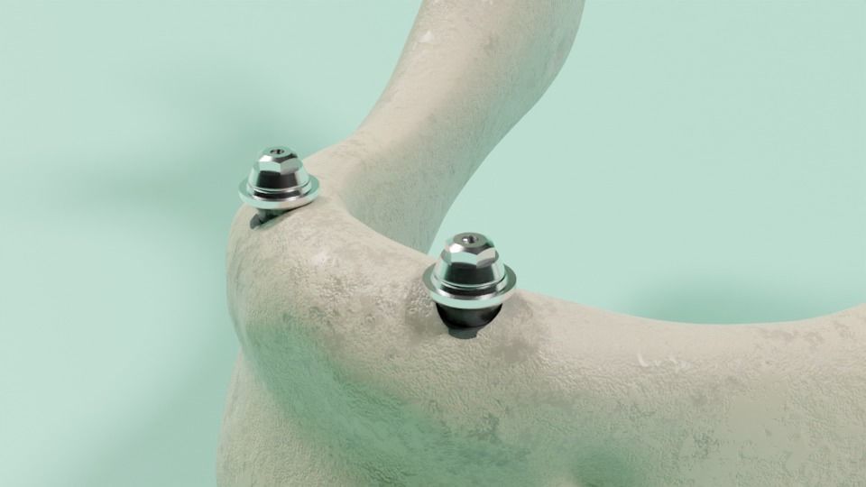 Overdenture - Bar-clip lower denture retained by implants 3D model_3