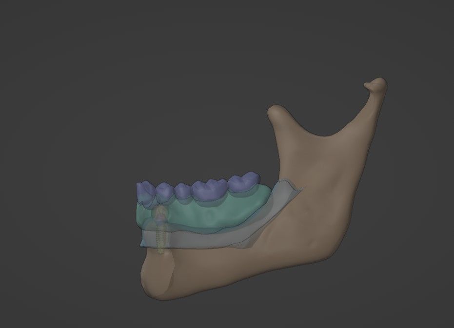 Overdenture - Bar-clip lower denture retained by implants 3D model_9