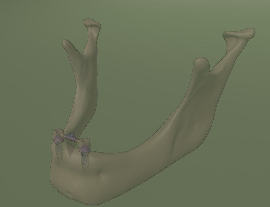 Overdenture - Bar-clip lower denture retained by implants 3D model_8