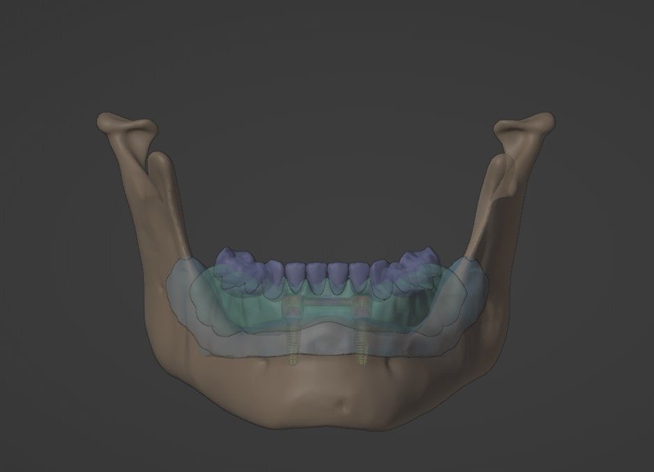 Overdenture - Bar-clip lower denture retained by implants 3D model_7