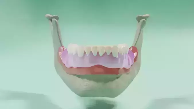 Overdenture - Bar-clip lower denture retained by implants