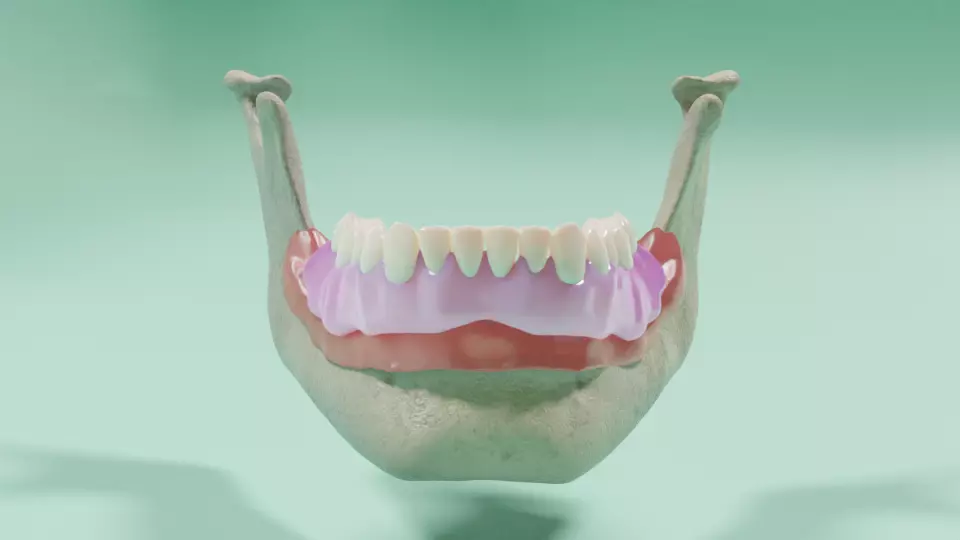 Overdenture - Bar-clip lower denture retained by implants 3D model_0